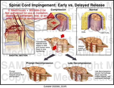 spinal cord compression diagnostic tests|spinal cord impingement vs compression.